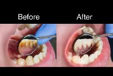 Free Dental Cleaning