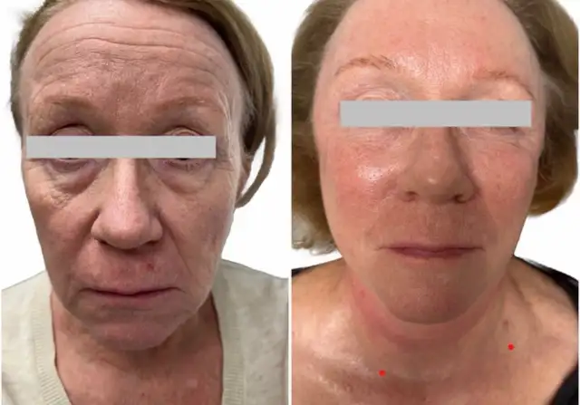 Nonsurgical Face Lift / skin tightening