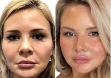 Nonsurgical Face Lift / skin tightening - Photo 2