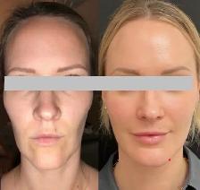Nonsurgical Face Lift / skin tightening - Photo 4