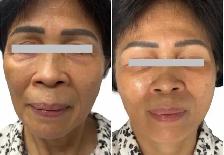 Nonsurgical Face Lift / skin tightening - Photo 5
