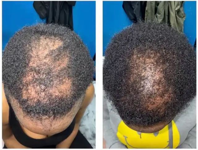 Hair Fall PRP / stem cell treatment