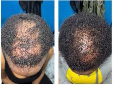Hair Fall PRP / stem cell treatment