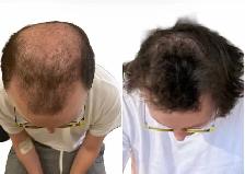 Hair Fall PRP / stem cell treatment - Photo 9