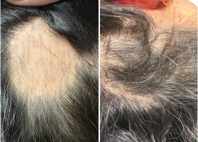 Stem Cell & PRP Hair loss Treatment