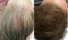 Stem Cell & PRP Hair loss Treatment - Photo 4