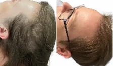 Stem Cell & PRP Hair loss Treatment - Photo 5