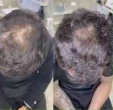 Stem Cell & PRP Hair loss Treatment - Photo 6