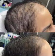 Stem Cell & PRP Hair loss Treatment - Photo 7