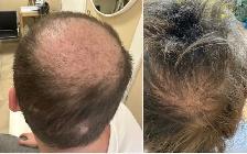 Stem Cell & PRP Hair loss Treatment - Photo 8