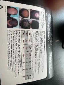 CNV Hair restoration laser cap - Photo 6