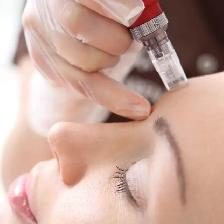 Facial, Microneedling, laser, fat freezing - Photo 2