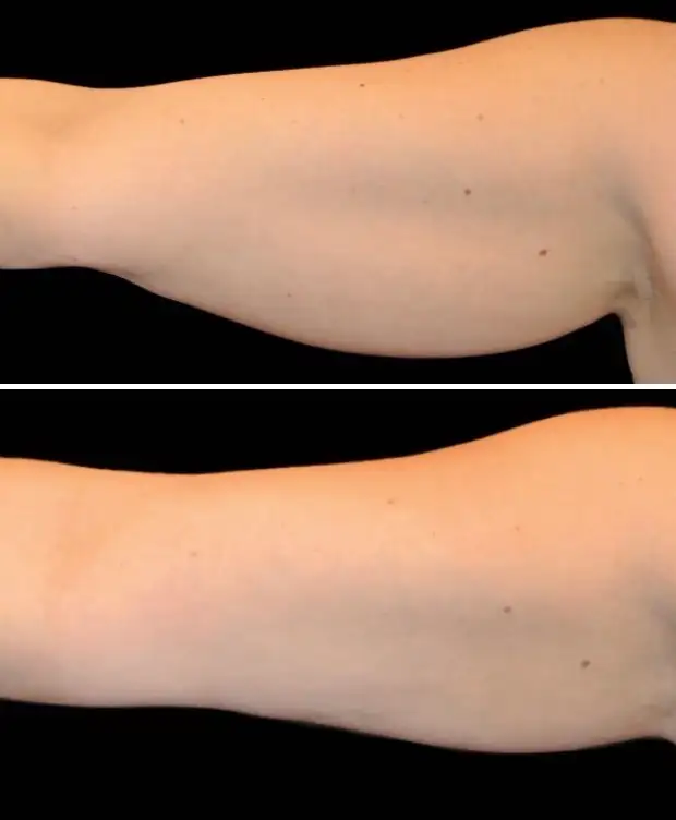 Stubborn Fat Removal (no surgical)