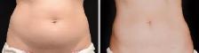 Stubborn Fat Removal (no surgical) - Photo 3