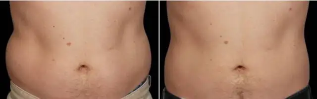 Stubborn Fat Loss Injections
