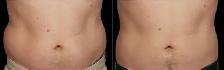 Stubborn Fat Loss Injections