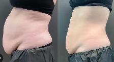 Stubborn Fat Loss Injections - Photo 3