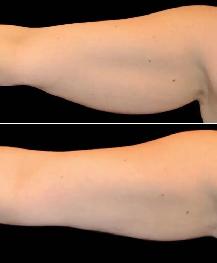 Stubborn Fat Loss Injections - Photo 4
