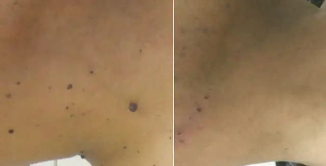 Skin Tag / Mole / Wart Removal