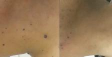 Skin Tag / Mole / Wart Removal