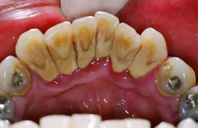 FREE Dental Cleaning & Dentist Check