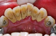 FREE dental Cleaning