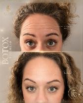 BRAMPTON | BOTOX® | $9 PER UNIT - Photo 2