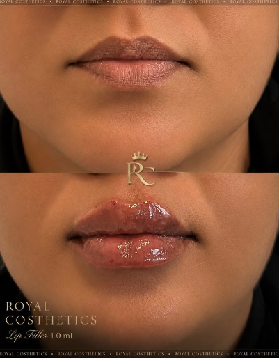 LIP FILLER - BRAMPTON