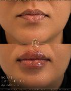 LIP FILLER - BRAMPTON