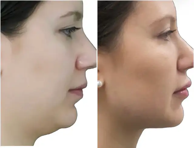 Fat Dissolving Injections (Permanent) Non-Surgical