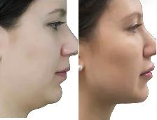 Fat Dissolving Injections (Permanent) Non-Surgical