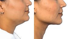 Fat Dissolving Injections (Permanent) Non-Surgical - Photo 2