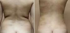 Fat Dissolving Injections (Permanent) Non-Surgical - Photo 3