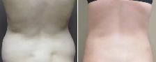 Fat Dissolving Injections (Permanent) Non-Surgical - Photo 4