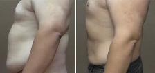 Fat Dissolving Injections (Permanent) Non-Surgical - Photo 5
