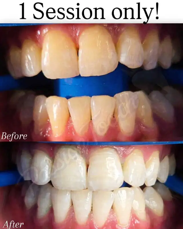 Dental Whitening Up to 10 Shades