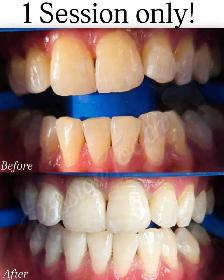Dental Whitening Up to 10 Shades