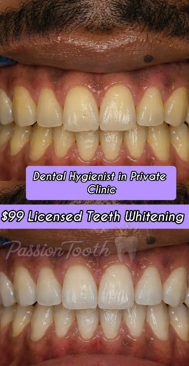 Dental Teeth Whitening $100 Flat