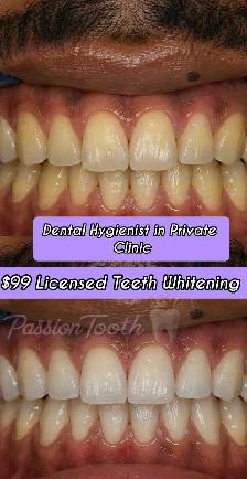 Dental Teeth Whitening $100 Flat