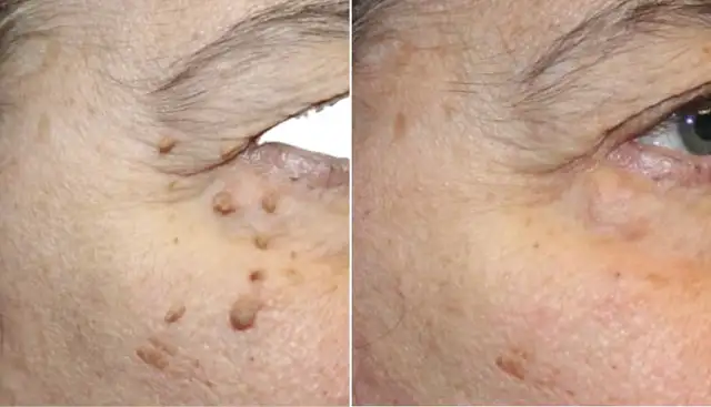 Skin Tag Removal