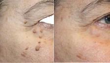 Skin Tag Removal