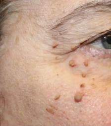 mole/skin tag Removed