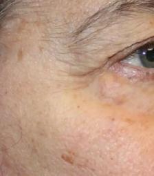 mole/skin tag Removed - Photo 2