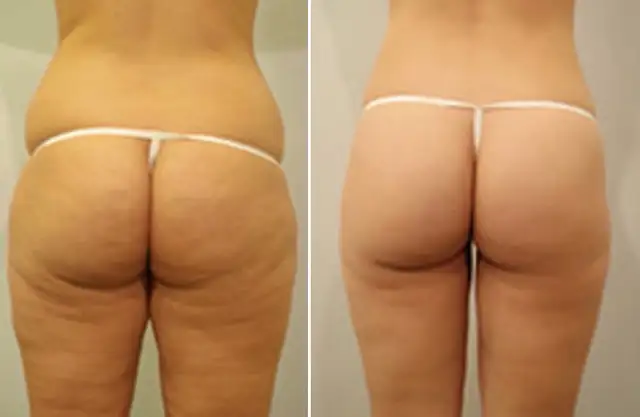 non-surgical Fat Removal