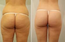 non-surgical Fat Removal