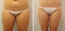 non-surgical Fat Removal - Photo 2