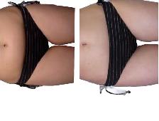 non-surgical Fat Removal - Photo 3