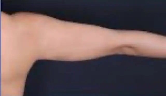 Permanent Fat Loss for stubborn fat.