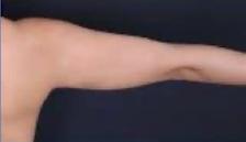Permanent Fat Loss for stubborn fat.