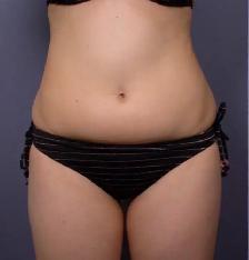 Permanent Fat Loss for stubborn fat. - Photo 3